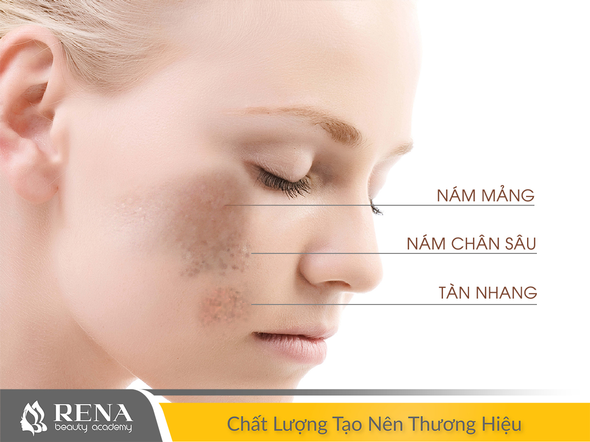 Khóa học Kỹ thuật viên spa: Chuyên đề trị nám và những điều cần lưu ý