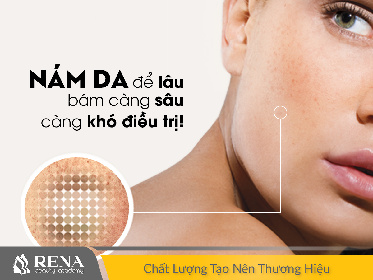 [Kiến thức nghề spa] Vạch trần nguyên nhân gây nám da ở phái nữ